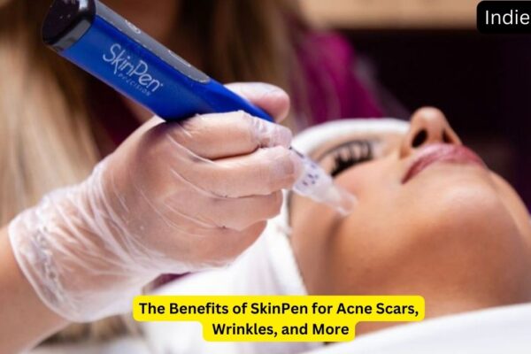 The Benefits of SkinPen for Acne Scars, Wrinkles, and More