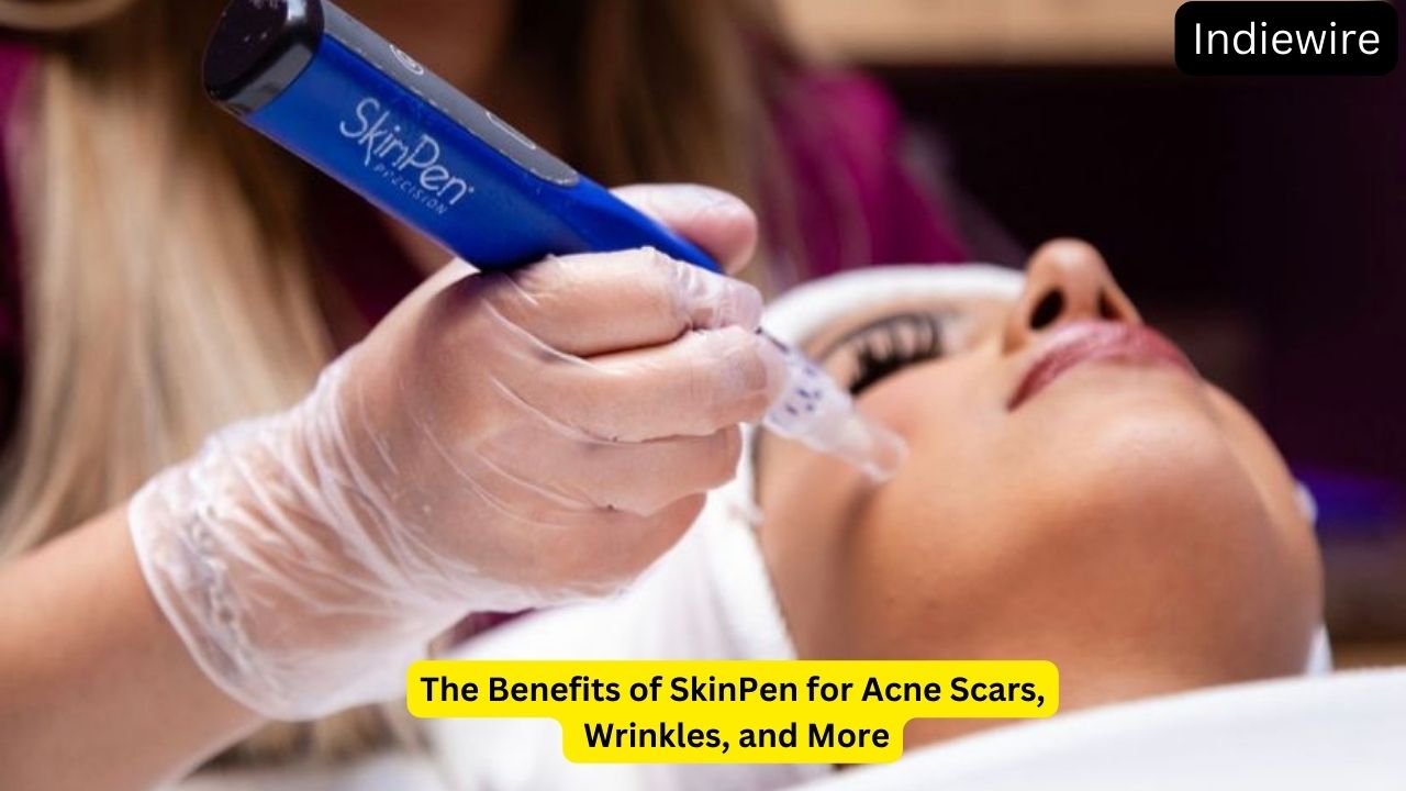 The Benefits of SkinPen for Acne Scars, Wrinkles, and More