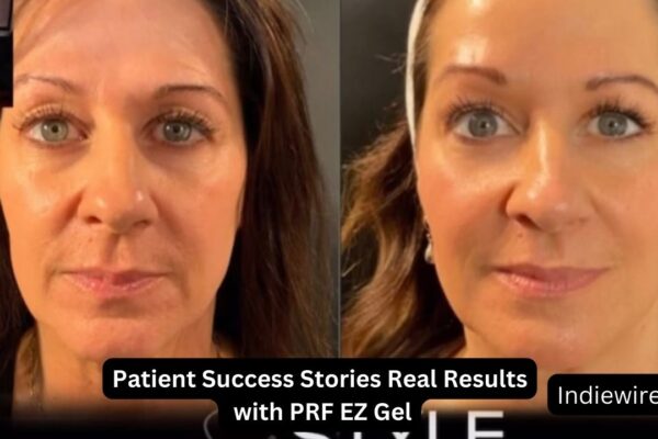 Patient Success Stories Real Results with PRF EZ Gel